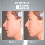 ViyaSkin® Dispositivo de contorno facial anti-idade